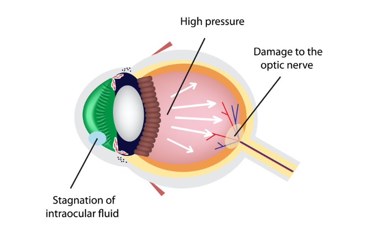 FDA批准Omlonti（奥米代尼帕格异丙基眼用溶液）用于降低原发性开角型青光眼或眼高压的眼压升高