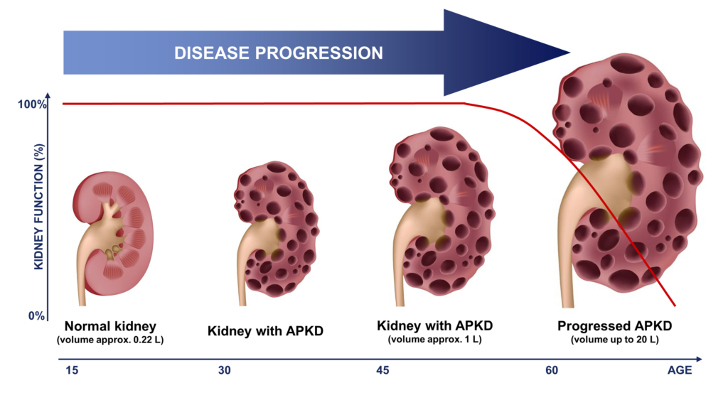 新药AP303获孤儿药认定，用于治疗常染色体显性遗传性多囊肾病（ADPKD）